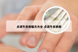 点滴牛皮癣偏方大全 点滴牛皮肤癣