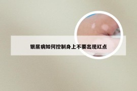 银屑病如何控制身上不要出现红点