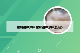 银屑病脚浮肿 银屑病脚浮肿怎么办