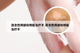 混合性阴部白斑能治疗不 混合性阴部白斑能治疗不