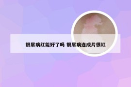 银屑病红能好了吗 银屑病连成片很红