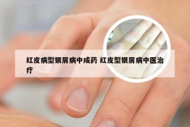 红皮病型银屑病中成药 红皮型银屑病中医治疗