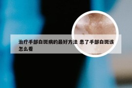 治疗手部白斑病的最好方法 患了手部白斑该怎么看