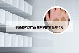 银屑病护肤产品 银屑病护肤品哪个好