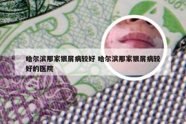 哈尔滨那家银屑病较好 哈尔滨那家银屑病较好的医院