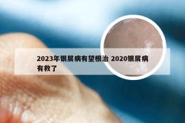 2023年银屑病有望根治 2020银屑病有救了