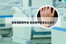 银屑病肌肤甲错 银屑病甲损害怎么治疗