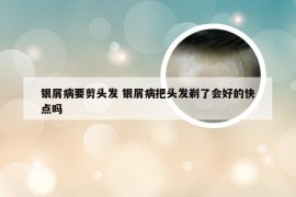 银屑病要剪头发 银屑病把头发剃了会好的快点吗