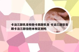 卡泊三醇乳膏和他卡西醇乳膏 卡泊三醇软膏跟卡泊三醇倍他米有区别吗