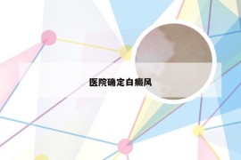 医院确定白癜风