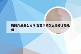 腹股沟癣怎么治疗 腹股沟癣怎么治疗才能除根