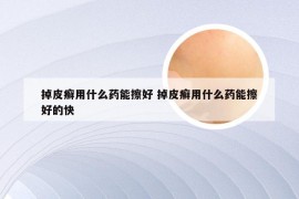 掉皮癣用什么药能擦好 掉皮癣用什么药能擦好的快