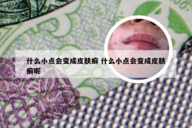 什么小点会变成皮肤癣 什么小点会变成皮肤癣呢