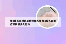 维a酸乳膏对银屑病效果怎样 维a酸乳膏治疗银屑病多久见效