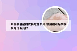 银屑病引起的皮损吃什么药 银屑病引起的皮损吃什么药好