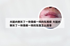 大腿内侧长了一块像癣一样的东西痒 大腿内侧长了一块像癣一样的东西怎么回事