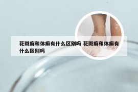 花斑癣和体癣有什么区别吗 花斑癣和体癣有什么区别吗