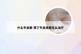 什么牛皮癣 得了牛皮皮癣怎么治疗