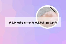 头上长头癣了用什么药 头上长癣用什么药膏