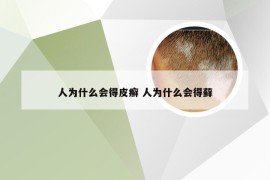 人为什么会得皮癣 人为什么会得藓