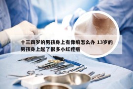 十三四岁的男孩身上有像癣怎么办 13岁的男孩身上起了很多小红疙瘩