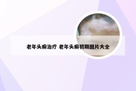 老年头癣治疗 老年头癣初期图片大全