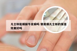 凡士林能缓解牛皮癣吗 银屑病凡士林的保湿效果好吗