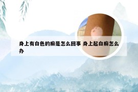 身上有白色的癣是怎么回事 身上起白癣怎么办