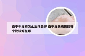 南宁牛皮癣怎么治疗最好 南宁皮肤病医院哪个比较好在哪