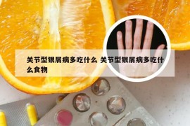 关节型银屑病多吃什么 关节型银屑病多吃什么食物