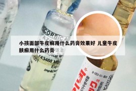 小孩面部牛皮癣用什么药膏效果好 儿童牛皮肤癣用什么药膏