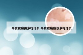 牛皮肤癣要多吃什么 牛皮肤癣应该多吃什么