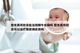 他克莫司软膏能治初期牛皮癣吗 他克莫司软膏可以治疗银屑病皮损吗