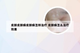 皮肤皮肤癣皮肤癣怎样治疗 皮肤癣怎么治疗效果