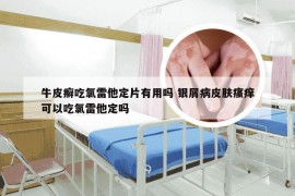 牛皮癣吃氯雷他定片有用吗 银屑病皮肤瘙痒可以吃氯雷他定吗