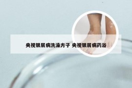 央视银屑病洗澡方子 央视银屑病药浴