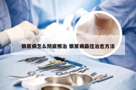 银屑病怎么彻底根治 银屑病最佳治愈方法