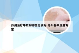 苏州治疗牛皮癣哪里比较好 苏州看牛皮屑专家