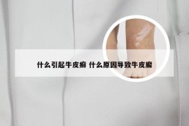 什么引起牛皮癣 什么原因导致牛皮廨