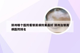 郑州哪个医院看银屑病效果最好 郑州治银屑病医院排名