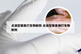 点滴型银屑打生物制剂 点滴型银屑病打生物制剂