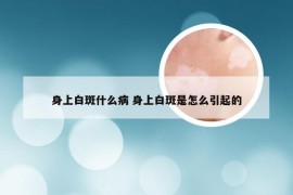 身上白斑什么病 身上白斑是怎么引起的