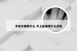 手皮长癣擦什么 手上起癣用什么药膏