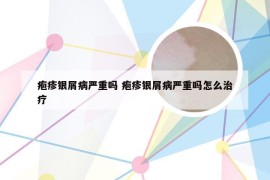 疱疹银屑病严重吗 疱疹银屑病严重吗怎么治疗