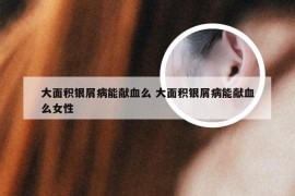 大面积银屑病能献血么 大面积银屑病能献血么女性