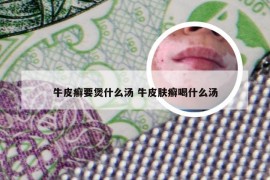 牛皮癣要煲什么汤 牛皮肤癣喝什么汤