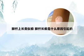 脚杆上长类似癣 脚杆长癣是什么原因引起的