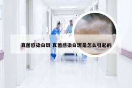 真菌感染白斑 真菌感染白斑是怎么引起的