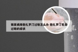 银屑病用他扎罗汀过敏怎么办 他扎罗汀乳膏过敏的症状