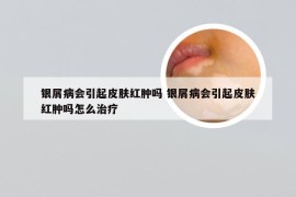 银屑病会引起皮肤红肿吗 银屑病会引起皮肤红肿吗怎么治疗